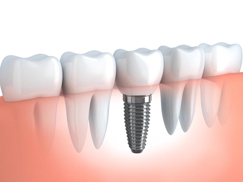 Dental Implants  Lakewood, CO 